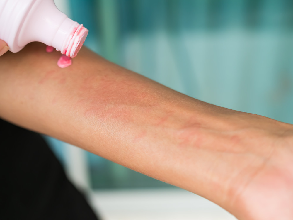 La calamine : causes, conséquences et solutions pour un phénomène méconnu